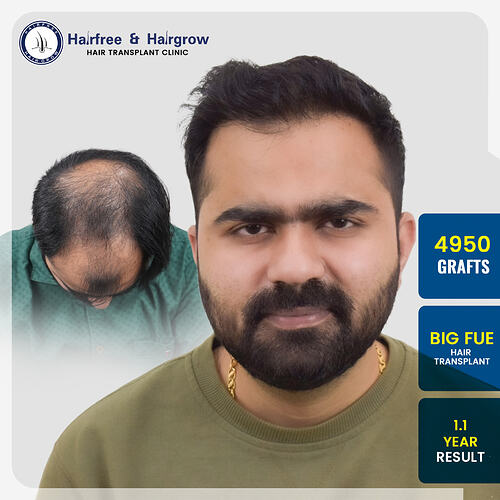 vipul-chaudhary-hair-transplant-result-pune-india-4950-grafts-big-fue-13-month.jpg