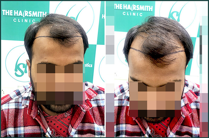 Before Hair Transplant HS 830- The Hairsmith Clinic Delhi India 1