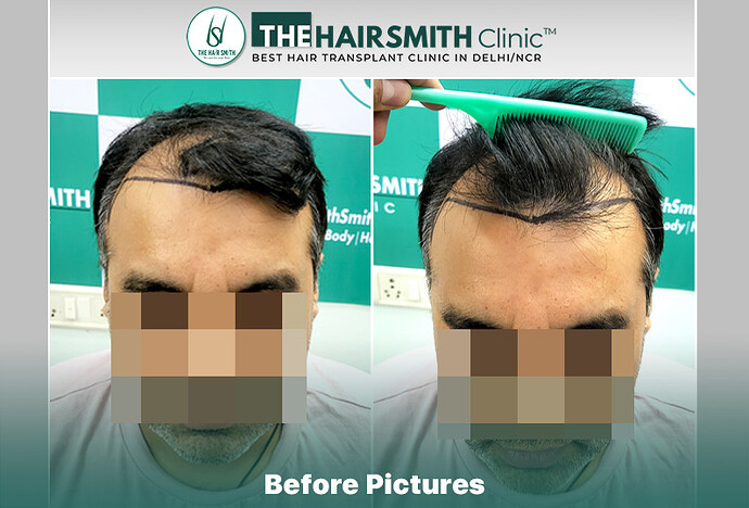 Before Hair Transplant HS 832- The Hairsmith Clinic Delhi India - 1