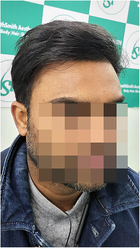 After 1 years hair transplant result update at the hairsmith clinic delhi india (3)