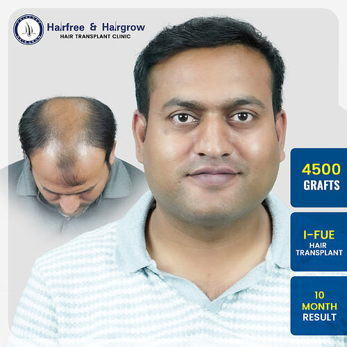 swapnil-dhawale-4500-grafts-i-fue-hair-transplant-10-month-result-pune.jpg