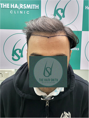 Patient Norwood stages 3 - Before  Picture (1) - The Hairsmith Hair Transplant Clinic