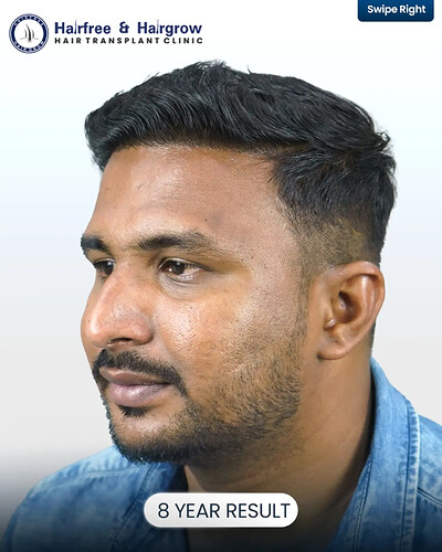 8 Years After Hair Transplant- Still Natural. A hair transplant is not just about immediate res (8)