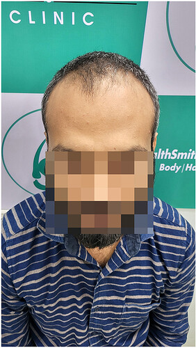 Before Hair Transplant - Norwood Stage 3 - photo 2- The Hairsmith Clinic