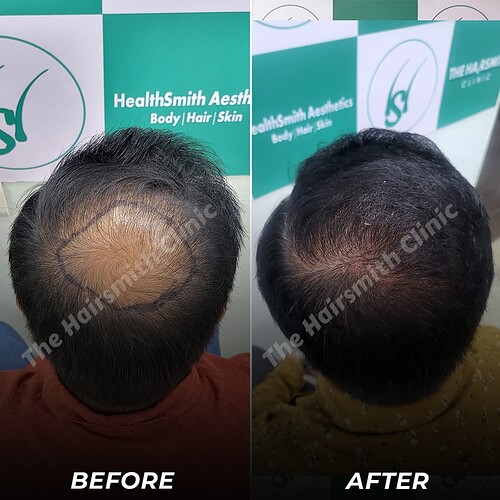 Best Hair Transplant Result - After 10 Months Update - The Hairsmith Clinic Delhi India - 5