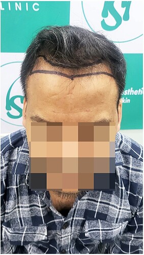 Before Hair Transplant HS 816 - The Hairsmith Clinic Delhi India - (2)