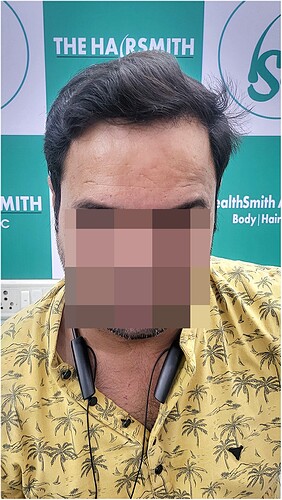 After1 Year Hair Transplant Result from The Hairsmith Clinic - 1