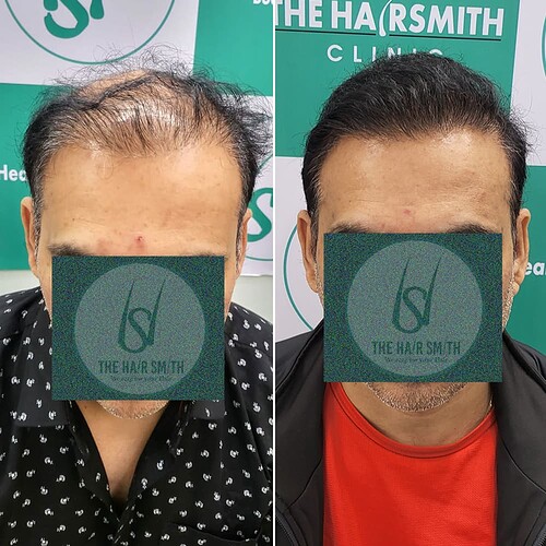 Best Hair Transplant Result Picture 1 - The Hairsmith Hair Transplant Clinic