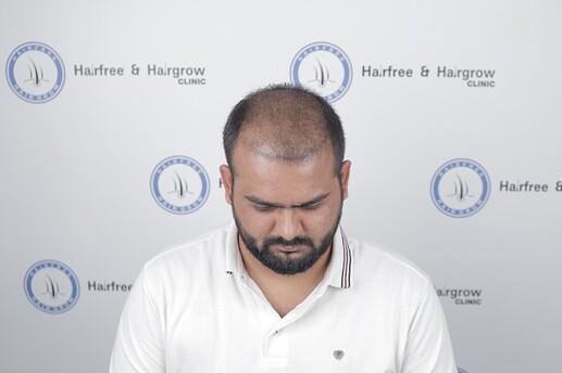 hair transplant shedding phase