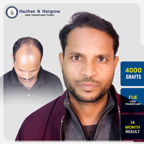 neeraj-singh-4000-grafts-fue-hair-transplant-14-month-result-pune.jpg