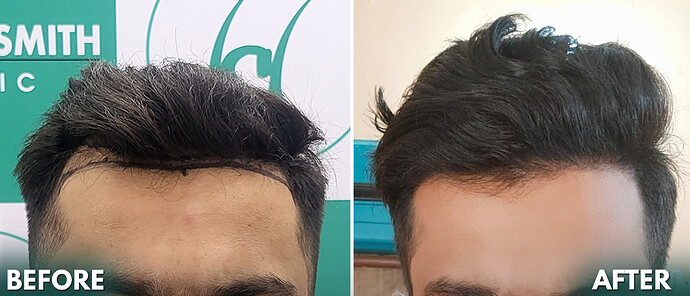 Hair Transplant Result - After 06 Months Update 1 - The Hairsmith Clinic