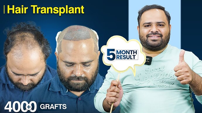 Harshwardhan Shinde's Hair Transplant Journey