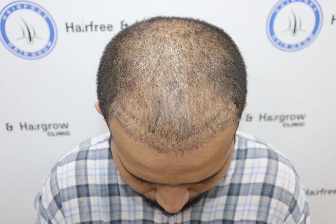 beforetransplant