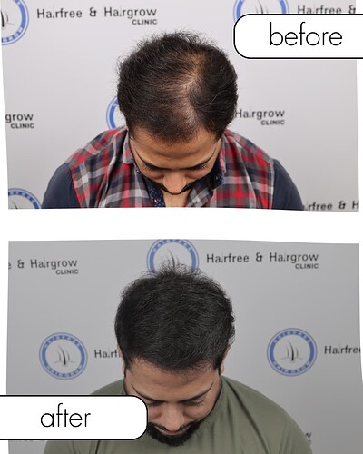 before and after hair transplant