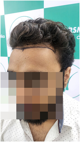 Before Hair Transplant - Norwood Stage 2 - photo 4- The Hairsmith Clinic
