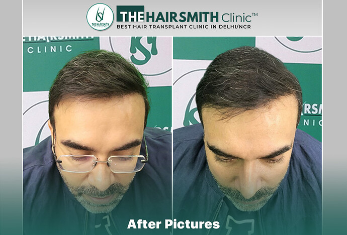after hair transplant - the hairsmith clinic delhi india #hairtransplant #thehairsmithclinic #besthairtransplantclinic