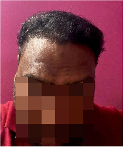 The Hairsmith Hair Transplant Result - After 8 Months Update