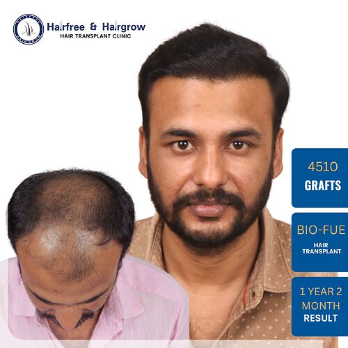 keval-kumar-bio-fue-hair-transplant-result-pune.jpg