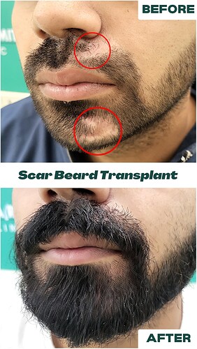 Beard Transplant Result - After 08 Months - The Hairsmith Clinic Delhi India - 2