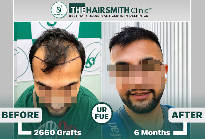 the hairsmith clinic hair transplant result #hairtransplant #hairsmithhairtransplant