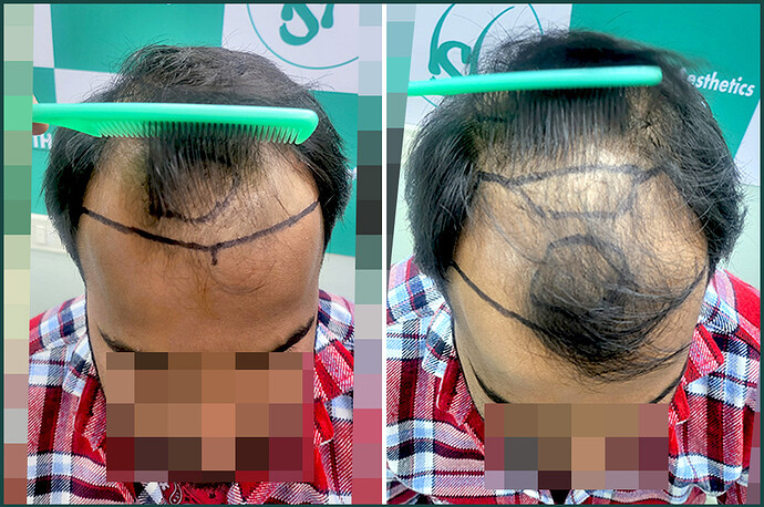 Before Hair Transplant HS 830- The Hairsmith Clinic Delhi India 3