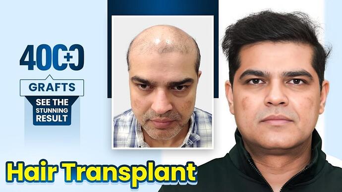 Rupesh Shukla’s Journey from Grade 7 Baldness to Hair Confidence