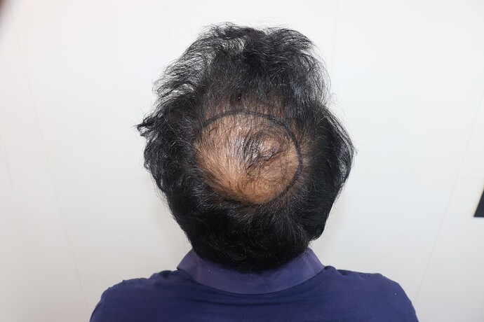 hair line marking