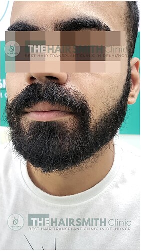 After Beard Transplant Result - 08  Months - The Hairsmith Clinic Dlehi NCR India - 2