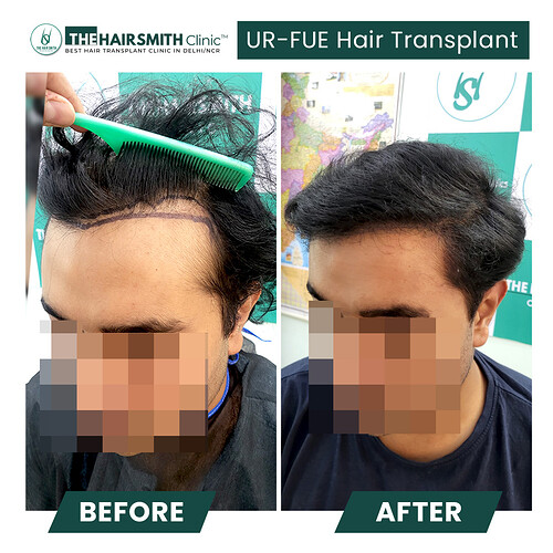 Amazing hair transplant result cp 4 - the hairsmith clinic