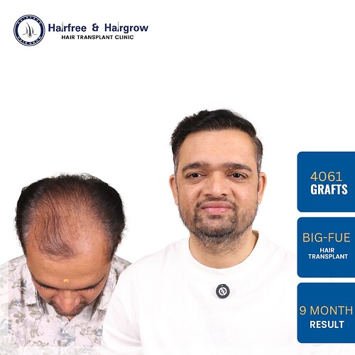 4061-grafts-big-fue-hair-transplant-9-month-result-pune.jpg