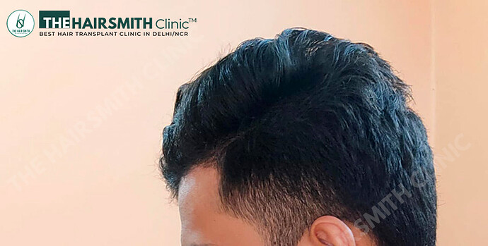 After Hair Transplant - 06 Months Update - Image 4 - The Hairsmith Clinic