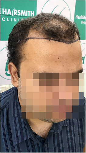 Before Hair Transplant HS 819- The Hairsmith Clinic Delhi India - (5