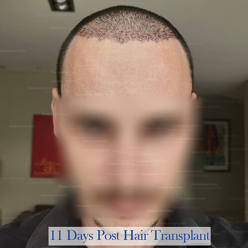 Diamond Hair Clinic in Turkey - Dr. Mehmet Demircioglu - Hair Transplant in Istanbul Turkey - Hair Transplant Patient Conor- 15