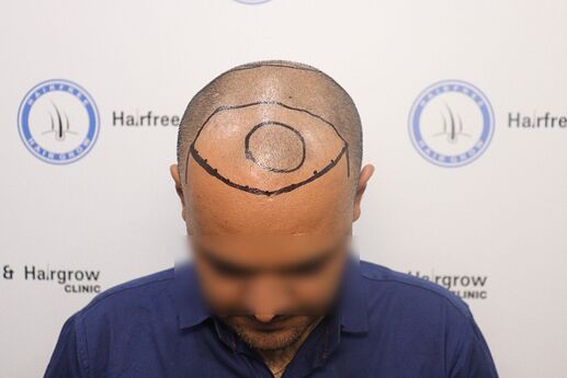 hair line marking