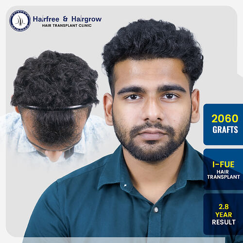 2060-grafts-i-fue-hair-transplant-2-8-year-result.jpg