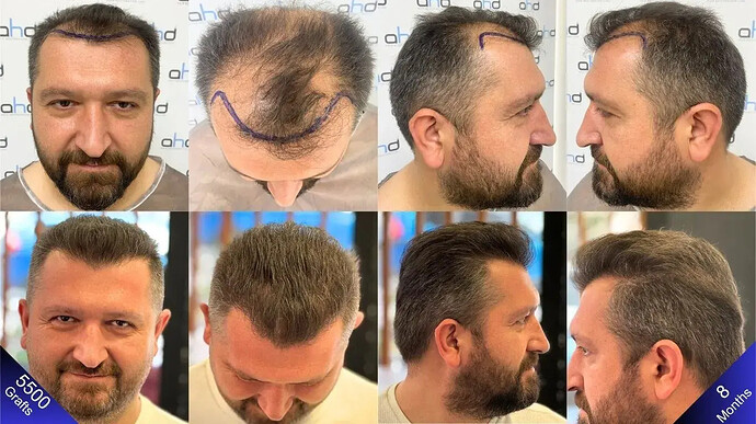 hair_transplant_result_turkey