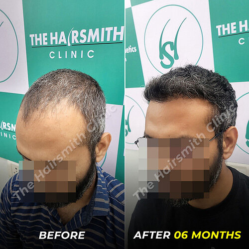 Hair Tarnsplant Befoe and After Result - photo 5 - The Hairsmith Clinic