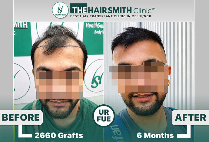 the hairsmith clinic hair transplant result #hairtransplant