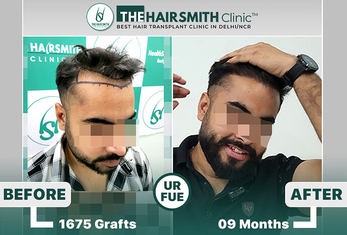 best hair transplant result - the hairsmith clinic