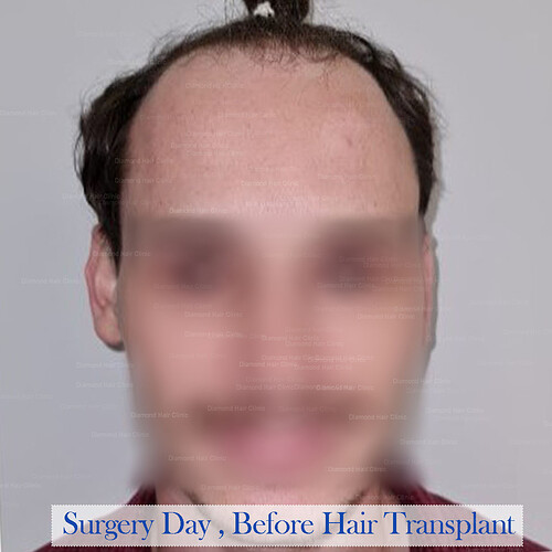 Diamond Hair Clinic in Turkey - Dr. Mehmet Demircioglu - Hair Transplant in Istanbul Turkey - Hair Transplant Patient Conor- 16