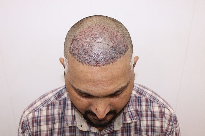after hair transplant
