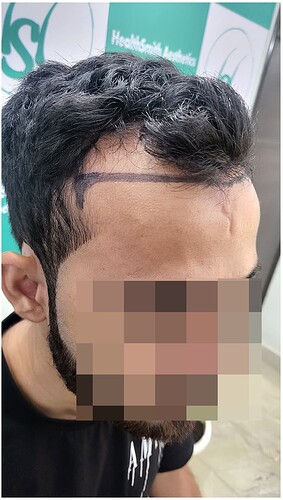 Before Hair Transplant HS 815 - The Hairsmith Clinic Delhi India - (4)