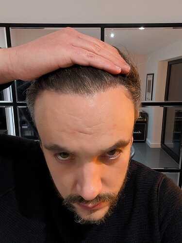 9. one year after Hairline