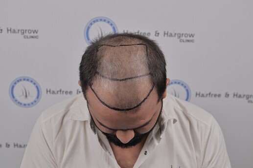 hair line marking