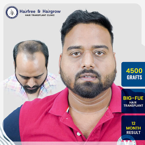 4500-grafts-big-fue-hair-transplant-12-month-result-manoj-kumar-barik-pune.jpg