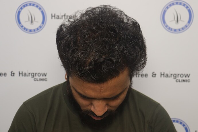 after 7-8 month hair transplant