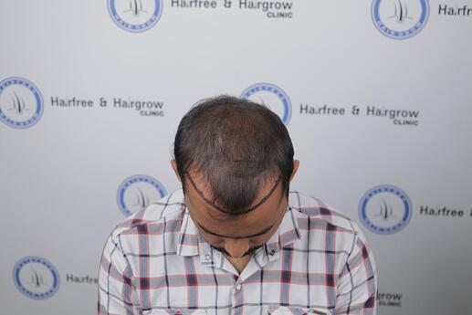 hair line marking