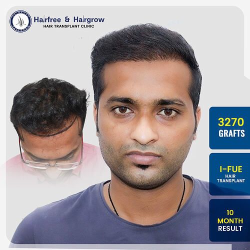 dr-krunal-solanki-hair-transplant-result-pune-3270-grafts-i-fue-10-month.jpg