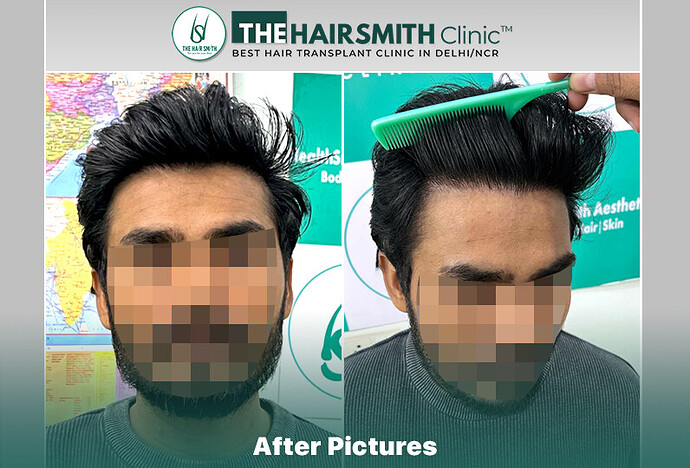 #hairtransplant #thehairsmithclinicdelhi #besthairtransplantclinic #naturalhairtransplant
