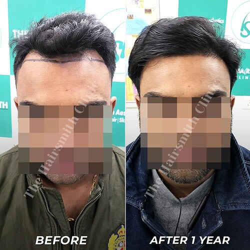 Hairsmith Hair Transplant Result - After 1 year  Update (5)